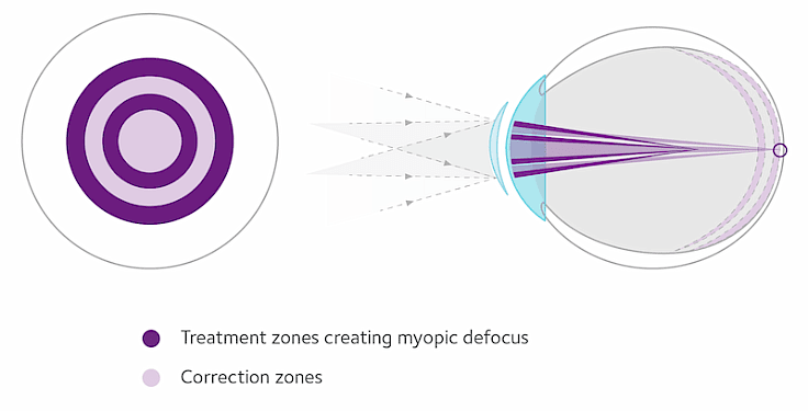 Illustration showing eye treatment zones designed to create myopic defocus for effective myopia control.